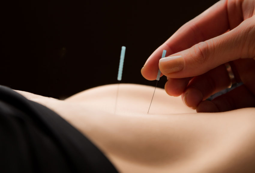 طب سوزنی یکی از راه های تنظیم قاعدگی از نظر طب سنتی طب سوزنی یکی از راه های تنظیم قاعدگی از نظر طب سنتی